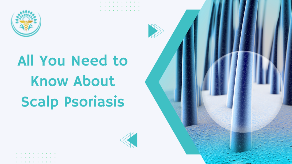 All You Need to Know about Scalp Psoriasis