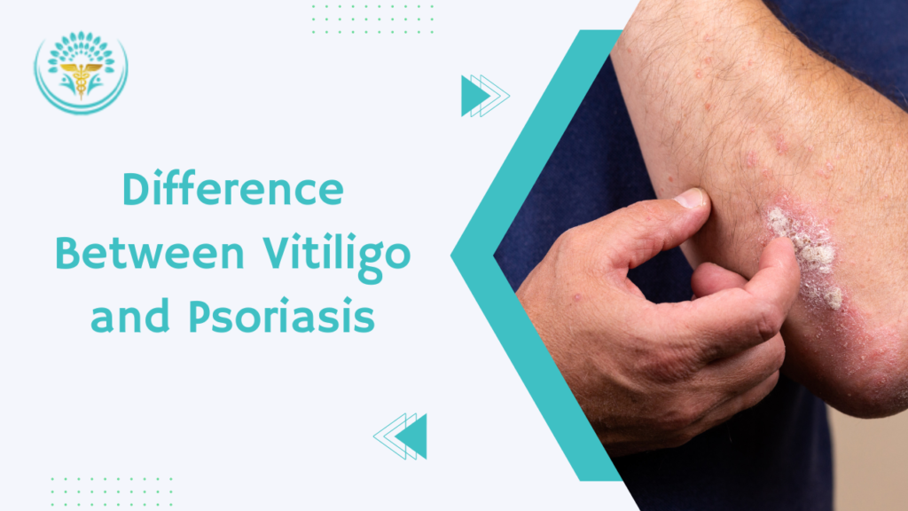 Difference Between Vitiligo and Psoriasis