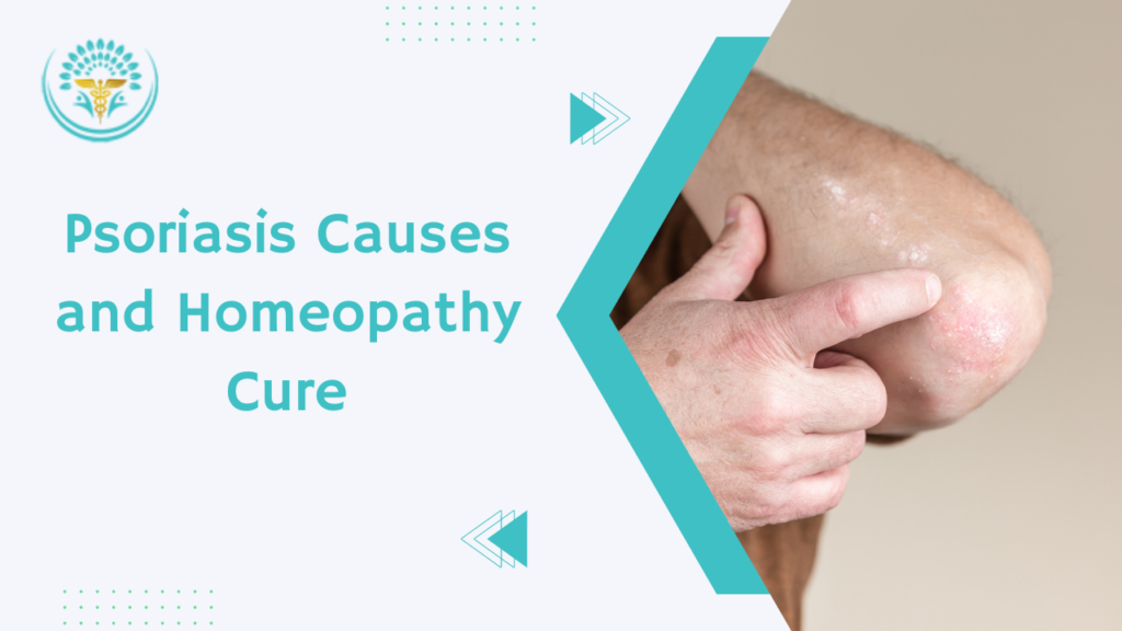 Psoriasis Causes and Homeopathy Cure