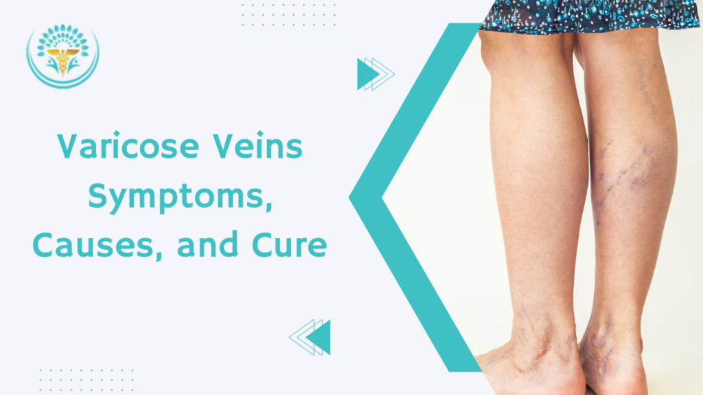 Varicose Veins Symptoms, Causes, and Cure