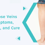 Varicose Veins Symptoms, Causes, and Cure