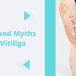 Vitiligo is an autoimmune disorder and its manifestation is characterized by discolouration or depigmentation of the skin and is not limited to any particular race. The melanocytes in the epidermis progressively destruct leading to patches of white skin. These cells contain melanin the colouring agent of the skin. Although vitiligo is not a painful condition, there is a lot of stigma attached due to the weird looks. This in turn adversely affects the quality of life of the person suffering from the disease and the patients often suffer from emotional distress and low self-esteem. They are at times subjected to social neglect, which in turn makes them move away from the main path. Half-filled scientific knowledge and baseless misconceptions are the key reasons for this undue apprehension. Proper diagnosis and treatment can set right the deranged immune system. The best homoeopathy doctor at Provitale Health, an expert in homoeopathy & aesthetics, popular in treating chronic ailments can treat vitiligo with excellent results. Cause The immune system which is designed to fight foreign bodies, like bacteria or viruses, etc for unknown reasons, targets the host System resulting in autoimmune disorders. There are over hundreds of such disorders. Vitiligo is common among auto-immune disorders. Vitiligo is seen as white patches on the skin. Patches are easily noticeable in people who have darker skin. Treatments for this condition overlap with other auto-immune ailments. When compared to other vitiligo treatments Myths & Facts Having given a brief outlook on vitiligo let us examine the facts behind this ailment with which you can burst myths surrounding vitiligo. There is a myth that the disease is contagious ie it can spread through contact with the affected person. However, Vitiligo is a self-limited ailment, which is non-contagious and does not spread by contact. There is no threat of contracting vitiligo by sharing the patient's personal items. Another myth is about eating habits. For instance, people used to attribute sour food, fish, white food, etc as the reason for vitiligo. However, this is not proven scientifically as there is no evidence to support this claim. On the contrary, people belonging to different religions, races, and socioeconomic groups with varying dietary habits hardly show any significant variation in their susceptibility towards the disease. Another disgusting myth that surrounds vitiligo is the belief of vitiligo and leprosy are the same. The tendency in Ayurveda was to use the suffix 'Kushta' for all skin diseases in Ayurveda. However, later it became synonymous with leprosy. A myth that vitiligo is caused by the curse of God or some bad deeds done in the past is totally baseless. It has been repeatedly proved that the disease is rather autoimmune in nature. Since pathophysiology is not known, the aetiology is not certain failing which several theories like genetic, neural, biochemical, autoimmune, autocytotoxic phenomenon and antioxidant deficiency theory have been out across. Stress, location of infection and impaired melanocyte migration to the skin, are also proven to contribute to the pathogenesis. The disease has a hereditary incidence ranging from 1.5 to 34%. It has been reported that vitiligo is associated with several other autoimmune disorders also. Although the course of the disease is unpredictable and uncertain, it generally shows a tendency towards slow progression. There is a myth that vitiligo is untreatable. In fact, Provitale Health, an expert in Homeopathy effectively treats vitiligo. The treatment is usually difficult and takes prolonged time; however, it is more important to treat the social stigma than the disease per se as the mental imbalance is far more traumatic than the effect on physical well-being. That's the advantage with us at Provitale Health, where you have the best Homeopathy Doctor to treat holistically. Now that you can leave the notion that vitiligo never heals. Conclusion Vitiligo, an autoimmune disorder, which is non-contagious is slowly progressive yet treatable. Several theories have been put forth so far, but the exact aetiology is not clear. Putting aside all the myths centred on vitiligo, Provitale Health has the best Medicines to treat it.