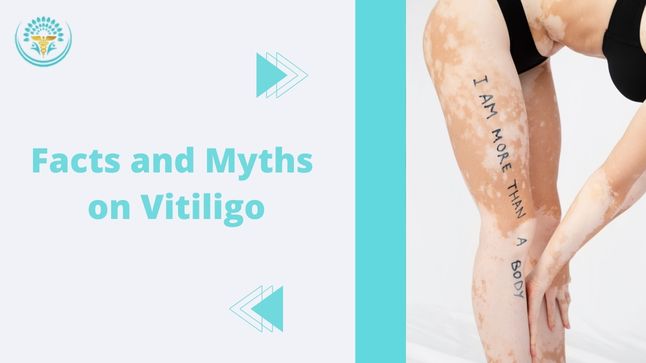 Vitiligo is an autoimmune disorder and its manifestation is characterized by discolouration or depigmentation of the skin and is not limited to any particular race. The melanocytes in the epidermis progressively destruct leading to patches of white skin. These cells contain melanin the colouring agent of the skin. Although vitiligo is not a painful condition, there is a lot of stigma attached due to the weird looks. This in turn adversely affects the quality of life of the person suffering from the disease and the patients often suffer from emotional distress and low self-esteem. They are at times subjected to social neglect, which in turn makes them move away from the main path. Half-filled scientific knowledge and baseless misconceptions are the key reasons for this undue apprehension. Proper diagnosis and treatment can set right the deranged immune system. The best homoeopathy doctor at Provitale Health, an expert in homoeopathy & aesthetics, popular in treating chronic ailments can treat vitiligo with excellent results. Cause The immune system which is designed to fight foreign bodies, like bacteria or viruses, etc for unknown reasons, targets the host System resulting in autoimmune disorders. There are over hundreds of such disorders. Vitiligo is common among auto-immune disorders. Vitiligo is seen as white patches on the skin. Patches are easily noticeable in people who have darker skin. Treatments for this condition overlap with other auto-immune ailments. When compared to other vitiligo treatments Myths & Facts Having given a brief outlook on vitiligo let us examine the facts behind this ailment with which you can burst myths surrounding vitiligo. There is a myth that the disease is contagious ie it can spread through contact with the affected person. However, Vitiligo is a self-limited ailment, which is non-contagious and does not spread by contact. There is no threat of contracting vitiligo by sharing the patient's personal items. Another myth is about eating habits. For instance, people used to attribute sour food, fish, white food, etc as the reason for vitiligo. However, this is not proven scientifically as there is no evidence to support this claim. On the contrary, people belonging to different religions, races, and socioeconomic groups with varying dietary habits hardly show any significant variation in their susceptibility towards the disease. Another disgusting myth that surrounds vitiligo is the belief of vitiligo and leprosy are the same. The tendency in Ayurveda was to use the suffix 'Kushta' for all skin diseases in Ayurveda. However, later it became synonymous with leprosy. A myth that vitiligo is caused by the curse of God or some bad deeds done in the past is totally baseless. It has been repeatedly proved that the disease is rather autoimmune in nature. Since pathophysiology is not known, the aetiology is not certain failing which several theories like genetic, neural, biochemical, autoimmune, autocytotoxic phenomenon and antioxidant deficiency theory have been out across. Stress, location of infection and impaired melanocyte migration to the skin, are also proven to contribute to the pathogenesis. The disease has a hereditary incidence ranging from 1.5 to 34%. It has been reported that vitiligo is associated with several other autoimmune disorders also. Although the course of the disease is unpredictable and uncertain, it generally shows a tendency towards slow progression. There is a myth that vitiligo is untreatable. In fact, Provitale Health, an expert in Homeopathy effectively treats vitiligo. The treatment is usually difficult and takes prolonged time; however, it is more important to treat the social stigma than the disease per se as the mental imbalance is far more traumatic than the effect on physical well-being. That's the advantage with us at Provitale Health, where you have the best Homeopathy Doctor to treat holistically. Now that you can leave the notion that vitiligo never heals. Conclusion Vitiligo, an autoimmune disorder, which is non-contagious is slowly progressive yet treatable. Several theories have been put forth so far, but the exact aetiology is not clear. Putting aside all the myths centred on vitiligo, Provitale Health has the best Medicines to treat it.