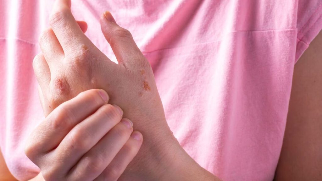   Eczema