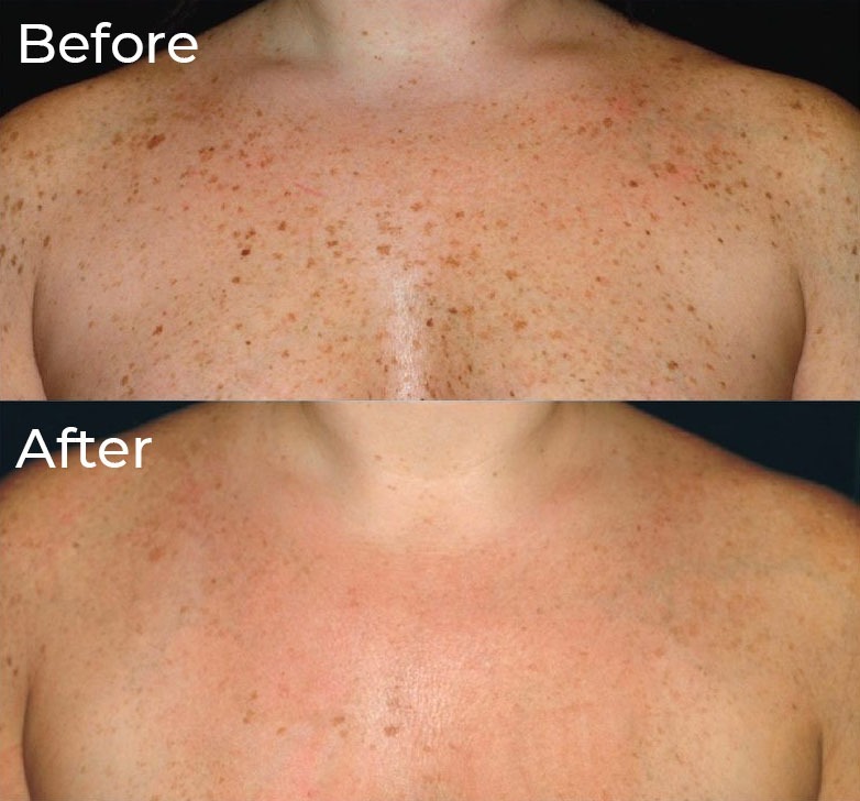 Homeopathy for melasma treatment