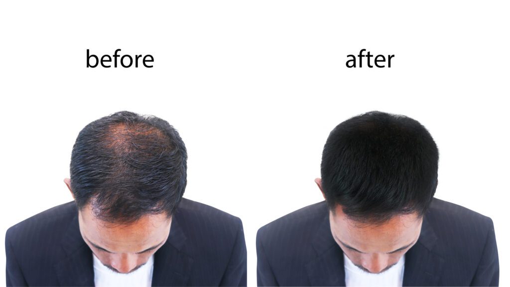 Understanding for hair loss