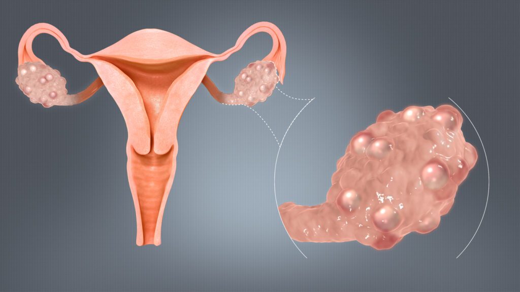 Understanding PCOS