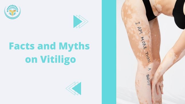 Vitiligo Treatments