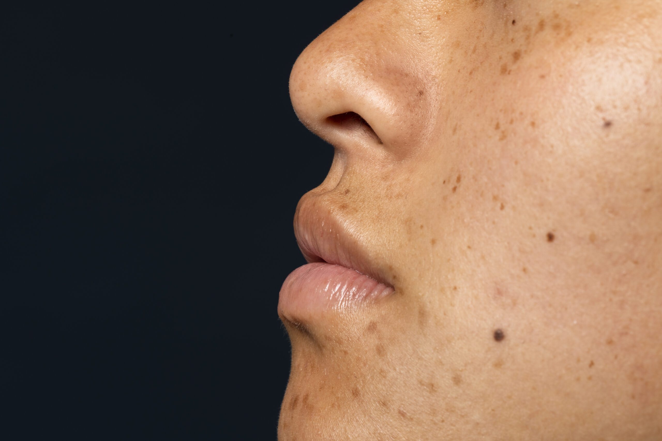 melasma treatment