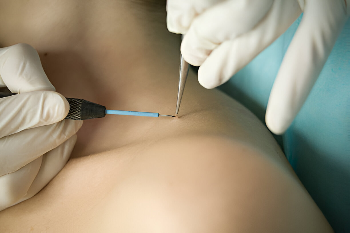 Homeopathy for wart removal