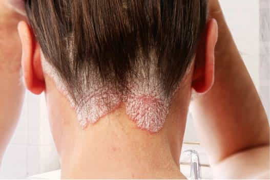 Psoriasis treatment with Homeopathy