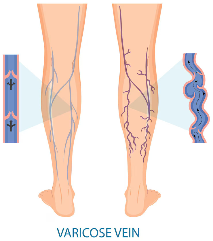 homeopathy for varicose veins