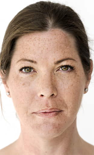 melasma treatment in homeopathy