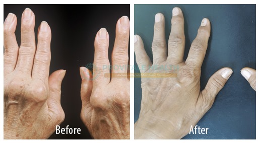 Rheumatoid Arthritis