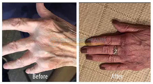 Rheumatoid Arthritis1