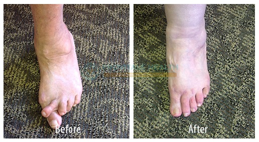 Rheumatoid Arthritis2