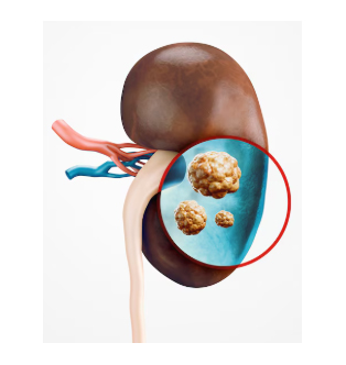 homeopathy treatment for Renal Cysts