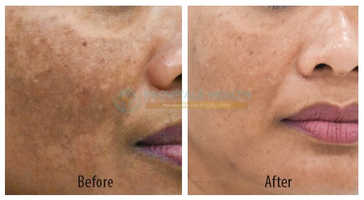 melasma2