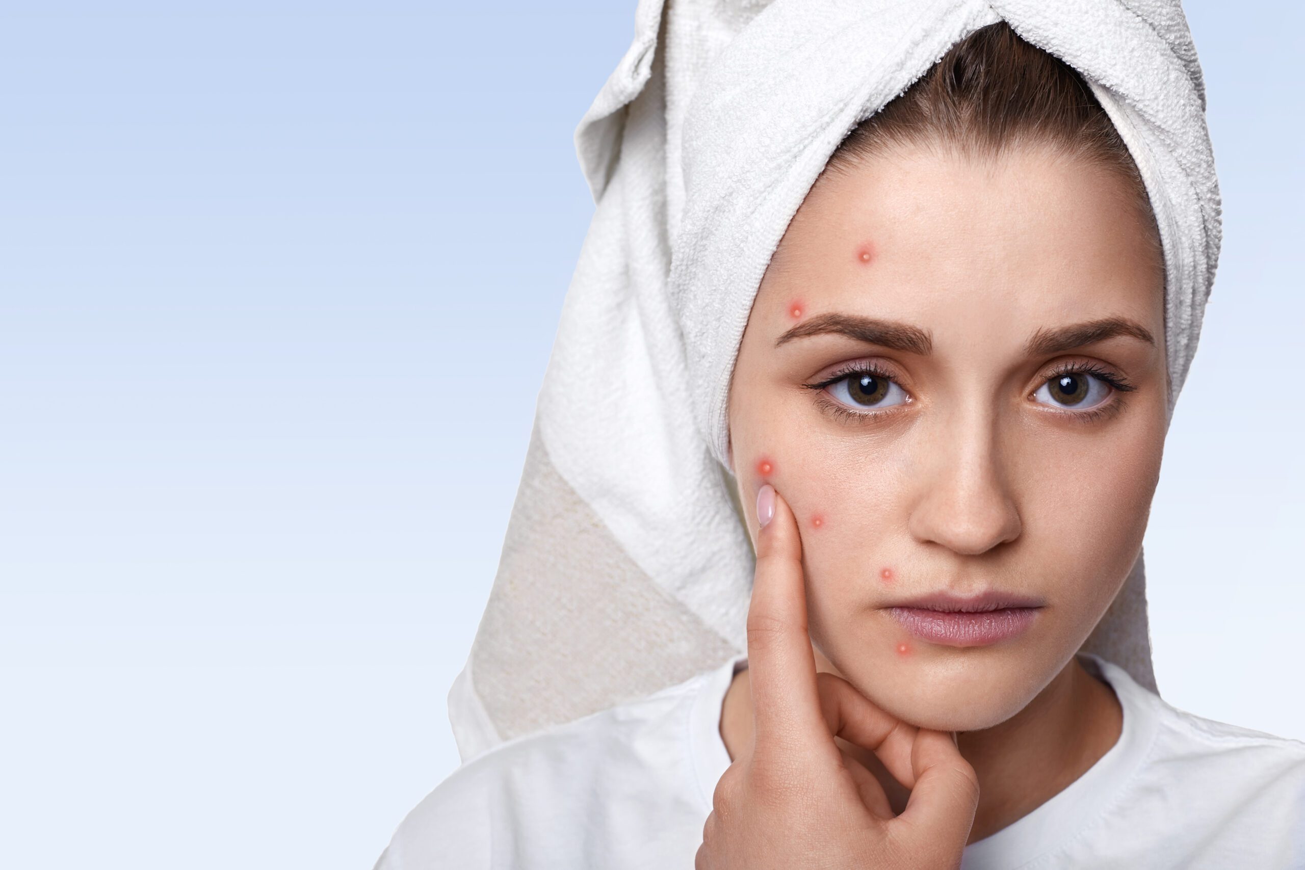 Homeopathy for acne